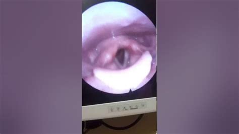 A Nasal Endoscopy Youtube