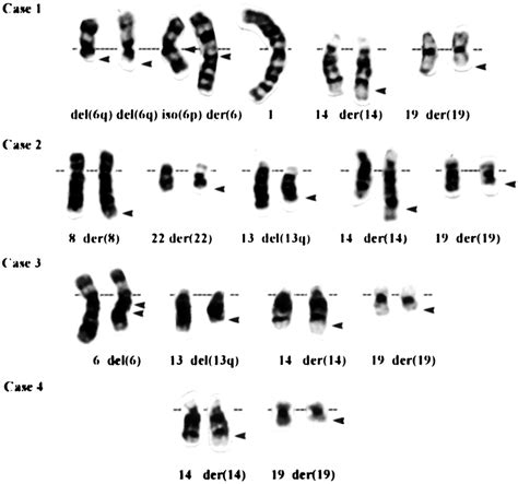 Partial Karyotypes Showing T 14 19 In The Four Cases With Secondary