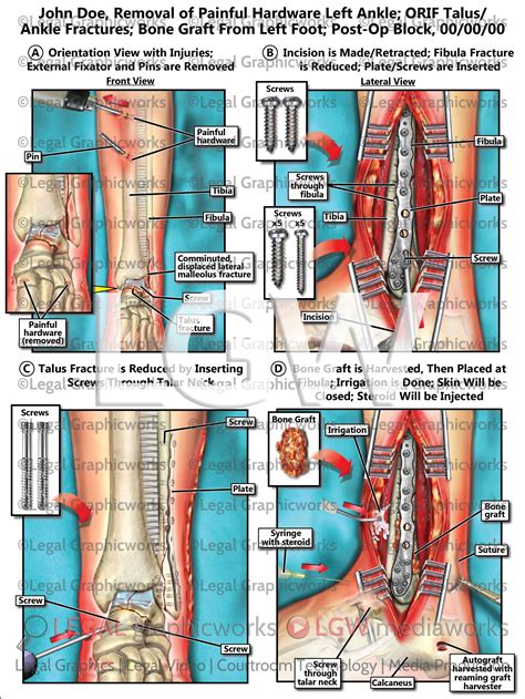 Removal of Painful Hardware Left Ankle; ORIF Talus/Ankle Fractures; Bo