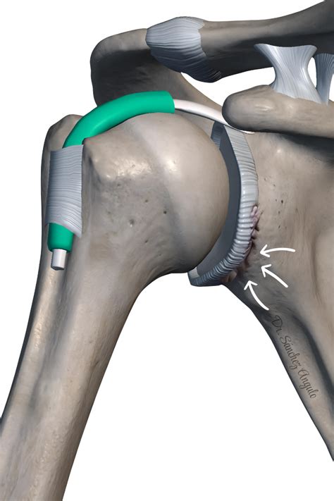 Qué es el labrum