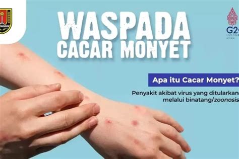 15 Kasus Cacar Monyet Diindentikasi Di Beberapa Daerah Di Indonesia