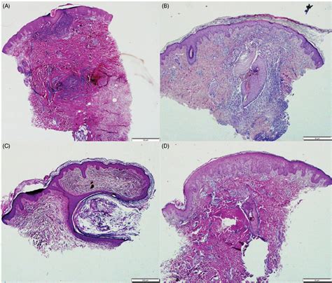 Acne Vulgaris Nodular Â 4 Papular Lesions Â 10 Comedonal Â Download Scientific