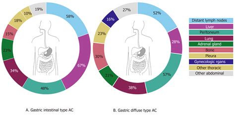 Metastatic Pattern In Esophageal And Gastric Cancer Influenced By Site And Histology