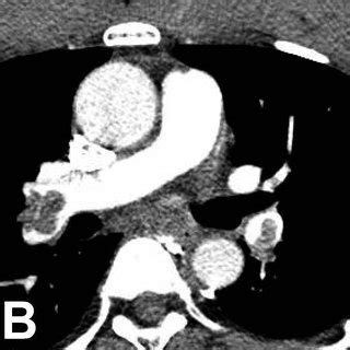 Computed Tomography Angiography Of Chest Showing A Bilateral