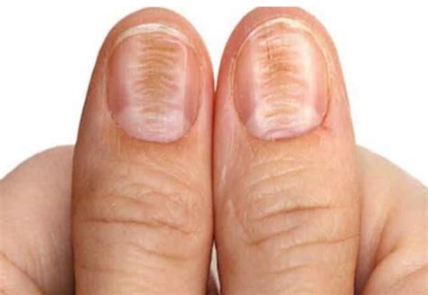 Can Iron Deficiency Cause Black Lines On Nails Design Talk