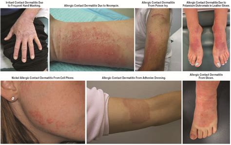 Jcm Free Full Text Diagnosis Of Atopic Dermatitis Mimics Overlaps