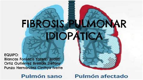 Fibrosis Pulmonar Idiop Tica Atziry Davila Udocz