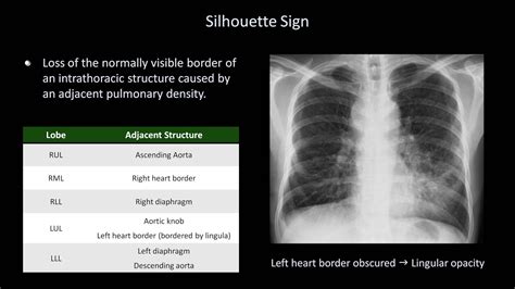 How To Interpret A Chest X Ray Lesson Focal Lung Processes Youtube