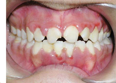 Figure 2 From Gingival Hyperplasia As An Early Diagnostic Oral