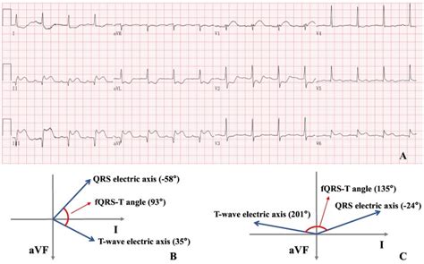 Prognostic Significance Of Qrs Distortion And Frontal Qrs T Angle In Patients With St Elevation