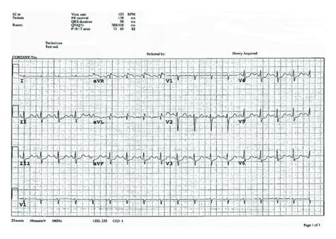 Initial 12-lead electrocardiogram showing diffuse ST segment depression ...