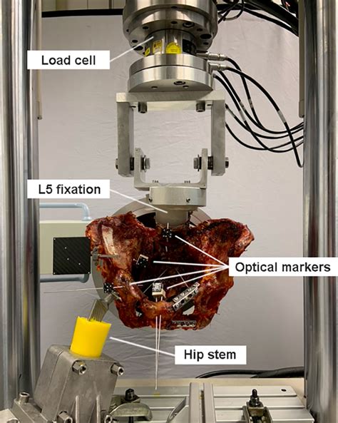 Sacroiliac Versus Transiliactranssacral Screw Osteosynthesis In