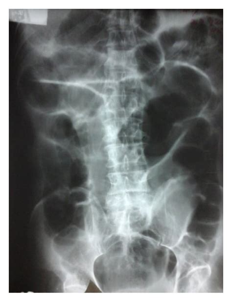 Supine X Ray Abdomen Showing Dilated Small Bowel Loops Download Scientific Diagram