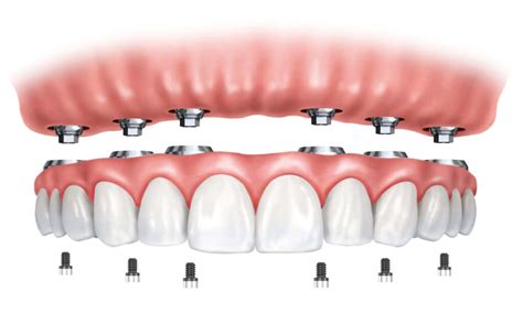 Proth Se Compl Te Sur Implants Docteurs Martinet Jacquin Et