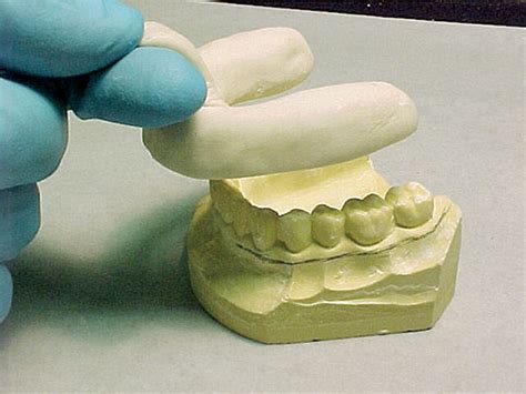 Fixed Prosthodontics Procedures Step by Step | Jan/Feb 2011 | Inside ...