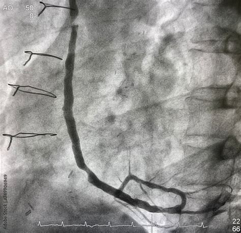 Coronary Angiogram Showed Saphenous Vein Graft SVG Was Stenosis After