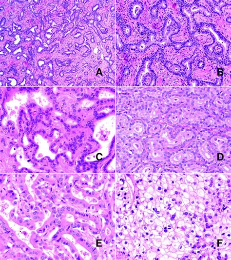 Cholangiolar Pattern And Albumin In Situ Hybridisation Enable A