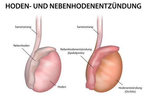 Hodenentz Ndung Orchitis Ursachen Symptome Behandlung