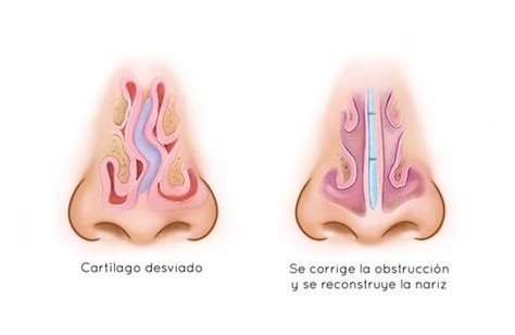 Tabique desviado y septoplastía cirugía de tabique nasal