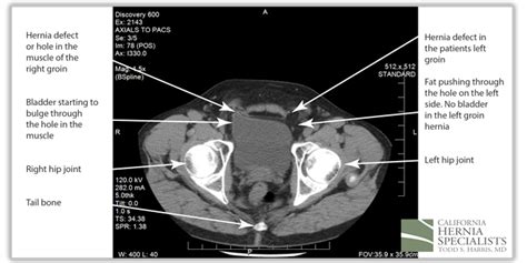 Recent Case Highlights California Hernia Specialists