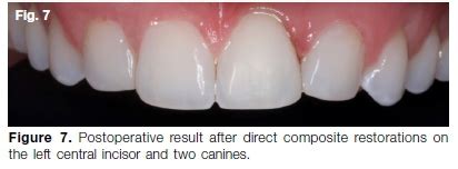 Calcific Metamorphosis A Review Of Literature And Clinical Management