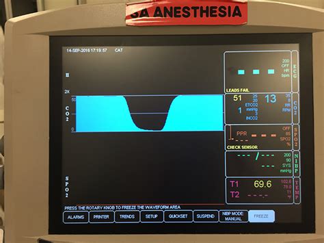 Image Gallery Capnography Clinicians Brief