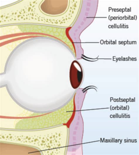 Orbital Cellulitis The Eyes Have It Em Board Bombs Podcast