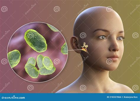 Haemophilus Influenzae Bacterie Als Oorzaak Van Otitis Media Stock