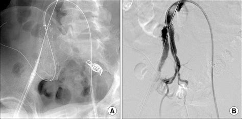 Figure 1 From Endovascular Treatment Of Isolated Bilateral Common Iliac