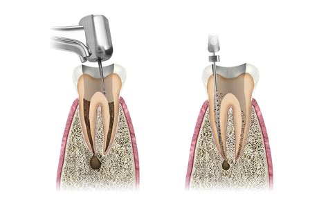 Endodonta Krak W Leczenie Kana Owe Pod Mikroskopem Krak W Cicho