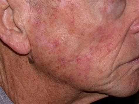 Actinic Keratosis On Skin Hot Sex Picture