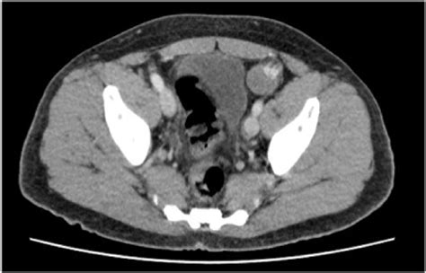 Axial CT scan showing an ovoid structure within the left iliac fossa ...