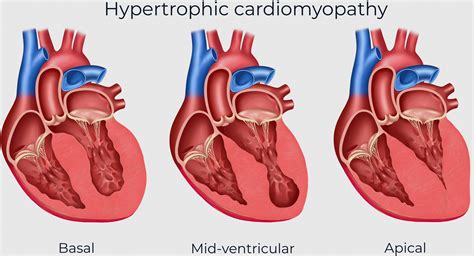 Invasive Management Of Hypertrophic Cardiomyopathy With Clinically