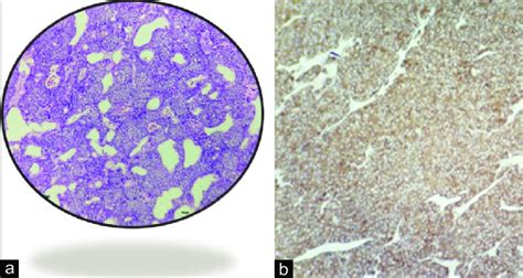 A Sheets And Islands Of Small Round Cell Tumour Involving The