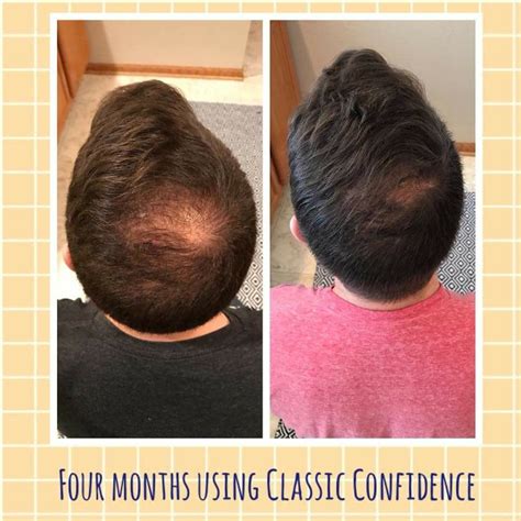 Before After Pics 2 Products Uses To Regrow Hair For Men Artofit