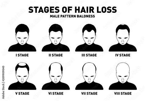 Hair loss. Stages and types of male hair loss. Male pattern baldness ...