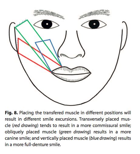 Gracilis Muscle Flap - Free Gracilis Muscle Transfer For Facial Paralysis