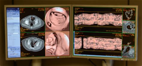 CT Colonography | Northern Virginia Radiology Consultants