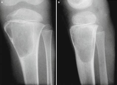 Simple Bone Cyst Musculoskeletal Key