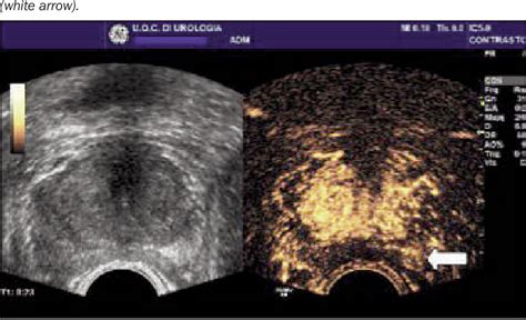 Figure 1 From Can Multiparametric Ultrasound Improve Cognitive Mri Trus