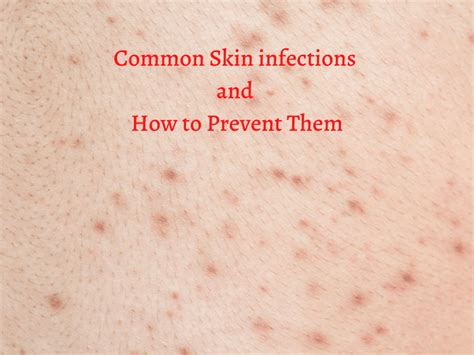 Common Skin infections and How to Prevent Them