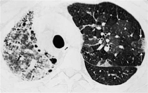 Constrictive Bronchiolitis HRCT Of Constrictive Bronchiolitis In A