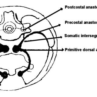 Showing The Origin Of Right Vertebral Artery From Subclavian Artery