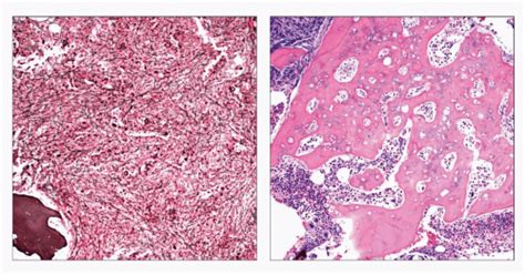 Primary Myelofibrosis | Basicmedical Key