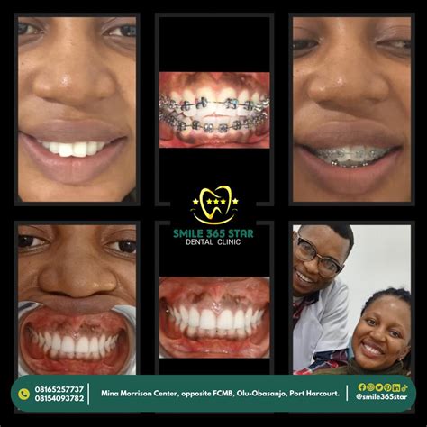 Transform Your Smile With Braces - Smile 365 Star Dental Clinic ...