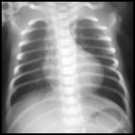 Pulmonary Atresia | Pediatric Radiology Reference Article | Pediatric Imaging | @pedsimaging