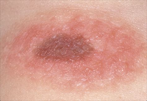 Congenital Skin Lesions