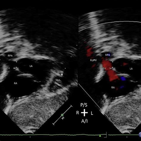 Two Dimensional And Color Doppler Echocardiogram From Patient 40 With