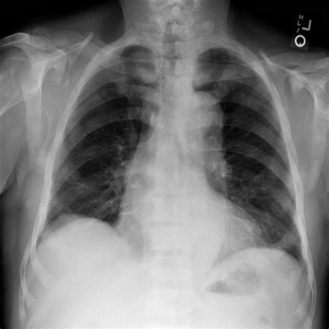 Pleural Effusion Chest X Ray Object Detection Dataset V