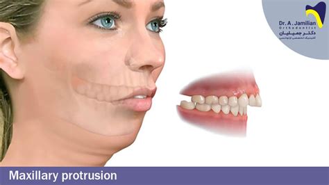 Maxillary Protrusion Dr Jamilian